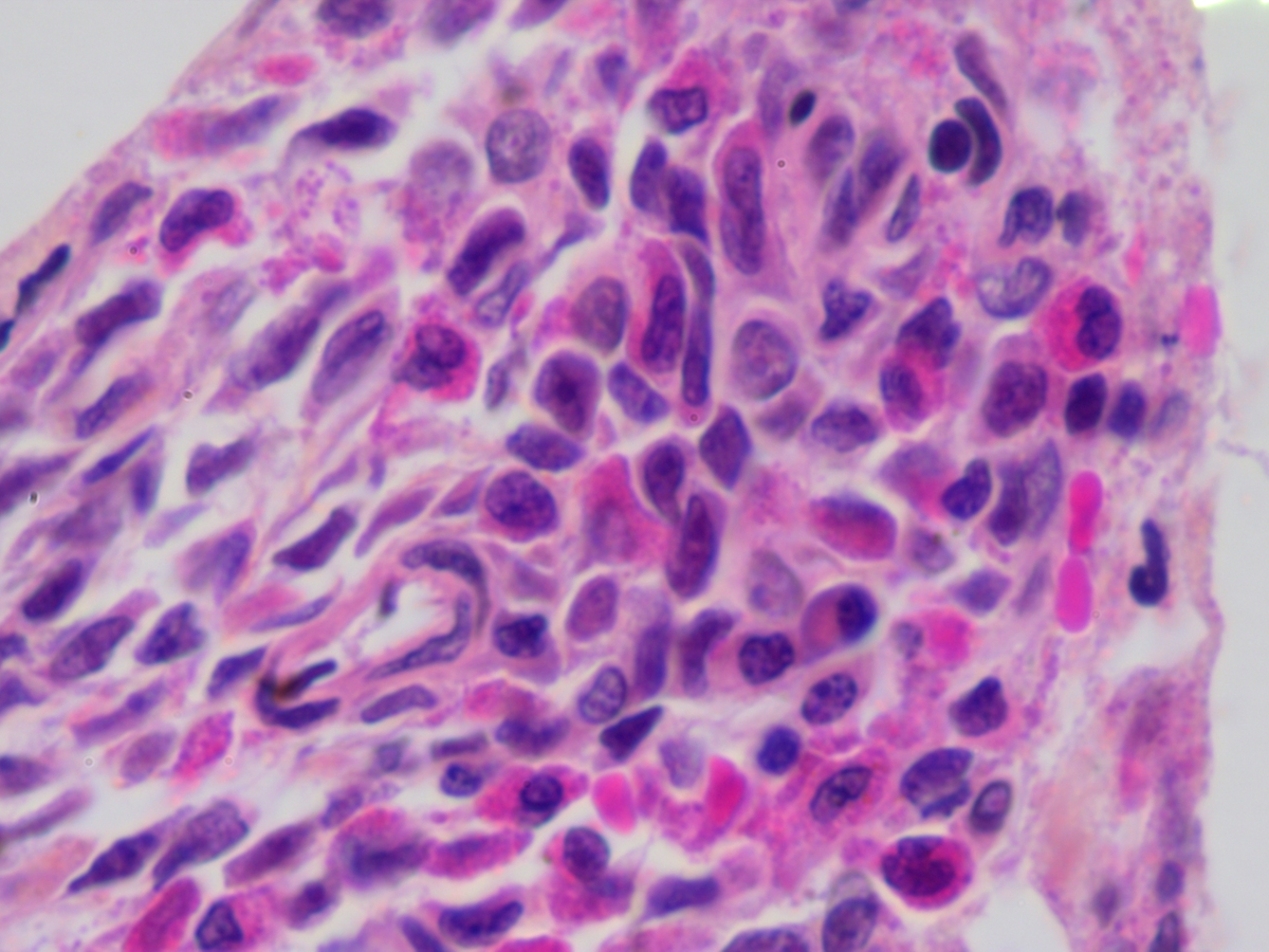 Initial bone marrow biopsy 40x